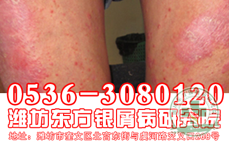 医生简述银屑病“防患于未然”很有必要