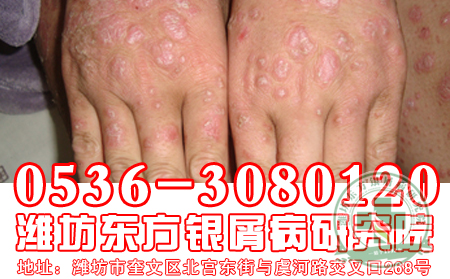 医生介绍银屑病患者宜食水果排行榜