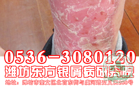 银屑病患者如何安排作息时间？