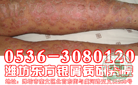 医生介绍：银屑病患者“食补”护肤法