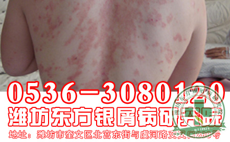 预防牛皮癣之路应如何走?