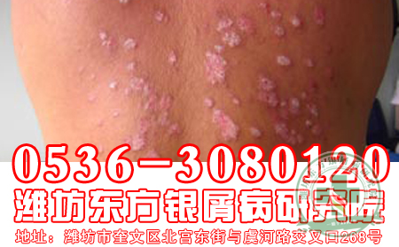 战胜银屑病需良可以心态