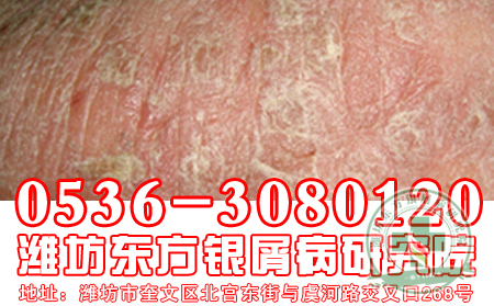 山东银屑病医院：银屑病怎样治疗 有效果？【指定医院】