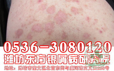 有没有人曾告诉你银屑病会因为什么发病？