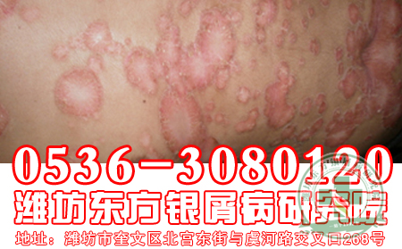 济南牛皮癣医院医生浅谈儿童牛皮癣症状介绍