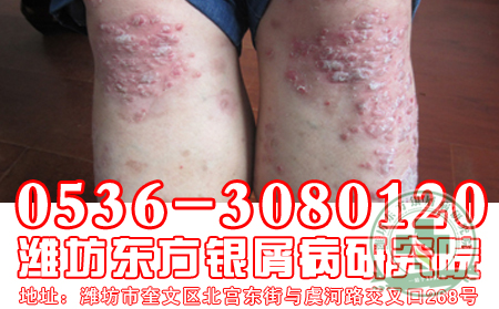 脓疱型银屑病的护理工作要注意的问题有什么？