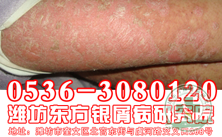 教大家如何区分风毒和银屑病？
