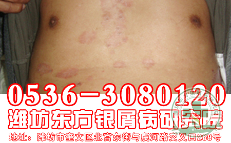 银屑病的治疗难度为什么会那么大？【绿色】