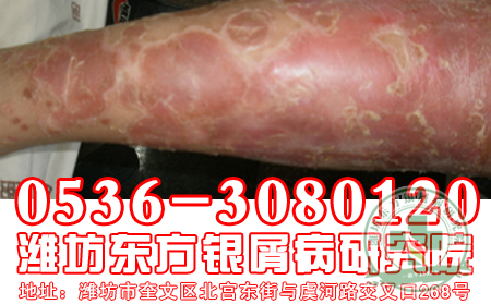 济南牛皮癣医院医院医生浅谈头皮牛皮癣护理问题