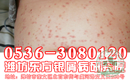 中医治疗牛皮癣的三大优势，帮我们在“尾牙” 牛皮癣！