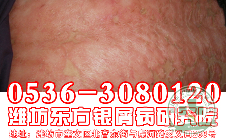 银屑病花多少钱能治可以？