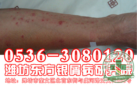 患者关注：牛皮癣护理我们有妙招