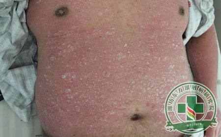 冬季银屑病防护要点——东方国际银屑病医院