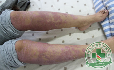 银屑病对症治疗才是王道——济南国际银屑病研究院