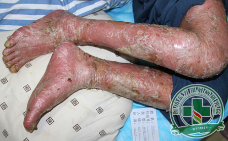  银屑病，我们有妙招——济南银屑病研究院