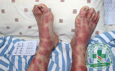 夏季牛皮癣患者怎样护理？