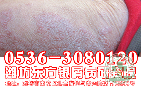牛皮癣患者怎样预防上火？