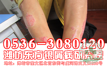 十年求医路，一朝病患除——一位银屑病恢复患者的自述