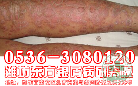怎么按摩帮助治疗银屑病