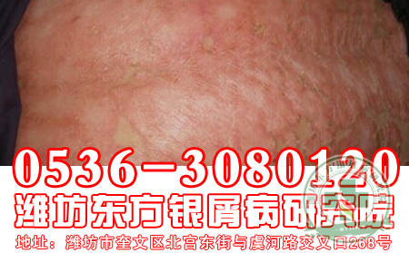 医生揭秘中青年群体患银屑病的病因所在