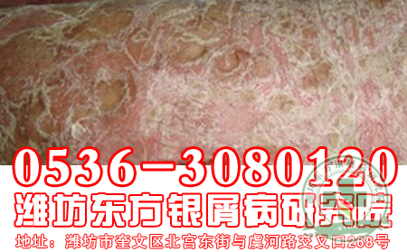 银屑病发病与哪些常见因素有关