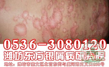 女性银屑病患者注意了！爱美不是错，方式要正确