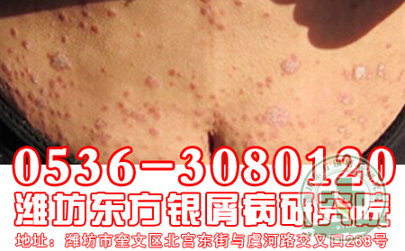 红皮病型银屑病如何诊断？请看医生给你指点一二