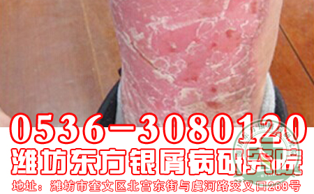 银屑病会遗传给子女吗