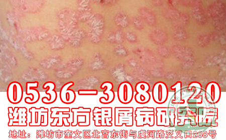 医生浅谈银屑病患者冬季饮食养生法