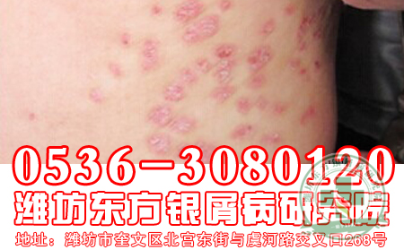 多笑可治疗银屑病