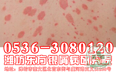 牛皮癣发病之后，患者身体会出现什么异常