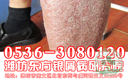 医生教你四小招，应对银屑病复发
