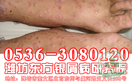 银屑病如何泡脚护理