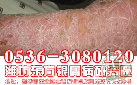 医生浅谈：银屑病患者冬季养生法