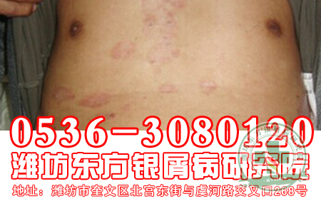 银屑病饮食是“双刃剑”，巧用才能除病