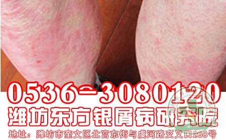 银屑病该怎么选择运动方式