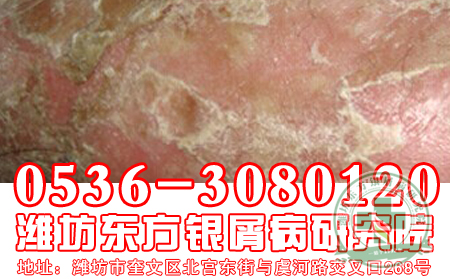 医生盘点：银屑病患者治疗须知