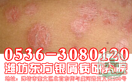 儿童银屑病与成人银屑病一样吗