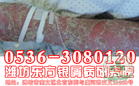 医生答疑：银屑病能否会造成脱发