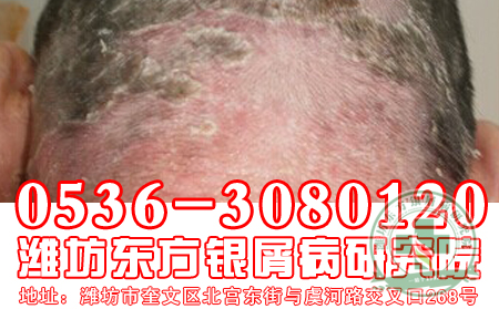 头癣属于银屑病吗