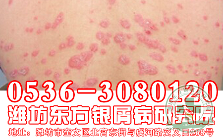 济南牛皮癣专科医院热线传温暖 施恩情系你我他