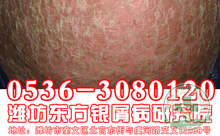 医生答疑,关于银屑病传染问题