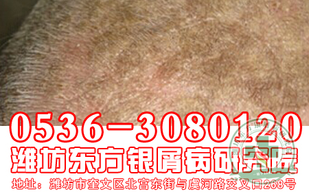 寻常型牛皮癣会因为什么原因发病