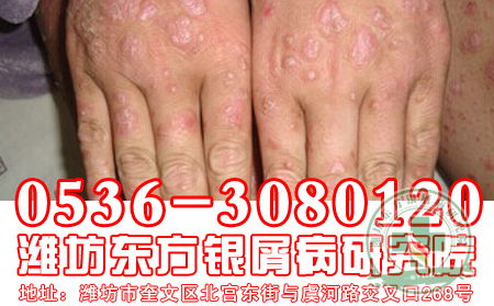 济南治疗牛皮癣专科医院皮损增厚是什么引起的