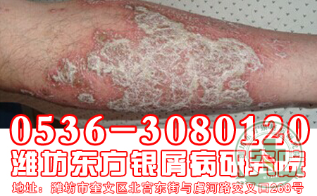 济南牛皮癣医院医生介绍：牛皮癣护理“吃醋”很重要