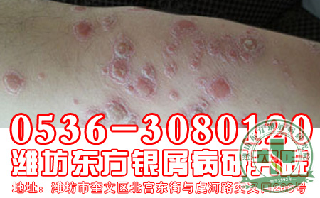 专业除“癣”，谁与争锋？