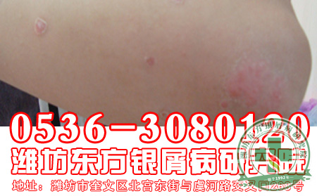那些年我们一起追过的银屑病女孩