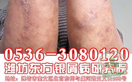 济南牛皮癣医院主任介绍预防牛皮癣复发的可以方法有哪些?