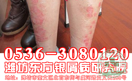 牛皮癣患者要及时补充“正能量”
