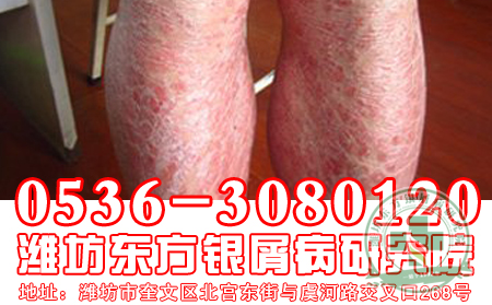 济宁牛皮癣医院医生教您如何护理皮肤